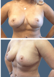 After breast, D to C cup