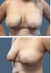 Before breast, D to C cup