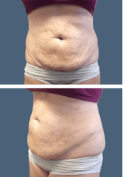 Before body