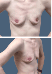 Before breast, 500cc, A to C cup