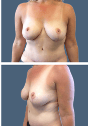 After breast, E to C cup
