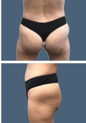 After body