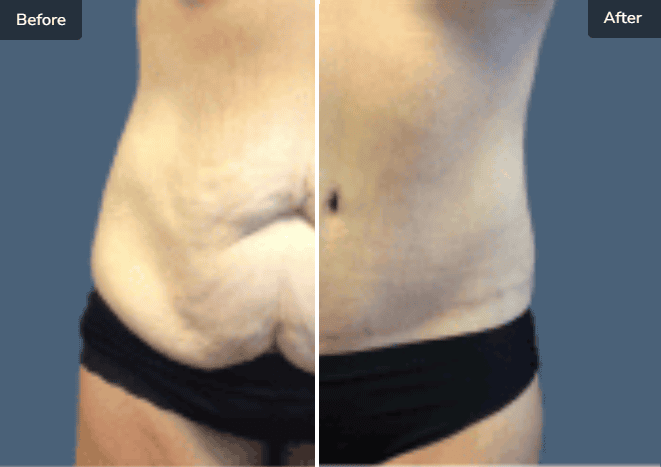 Before and After Body Procedures