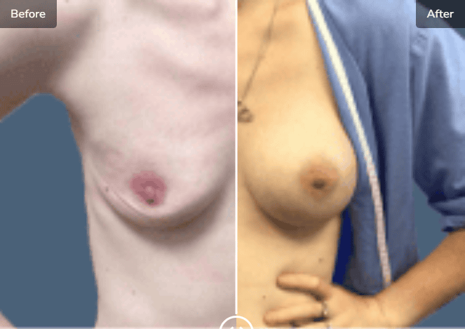 Before and After Breast Procedure