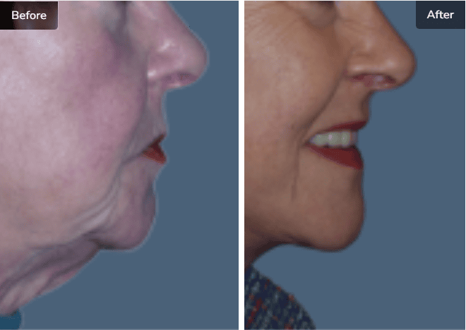 Before and After Facial Procedures