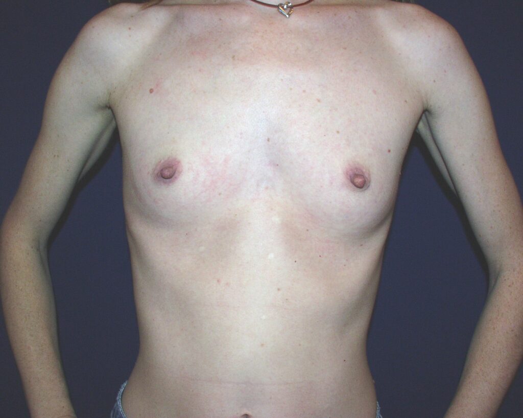 Before breast, 350cc, AA to C cup
