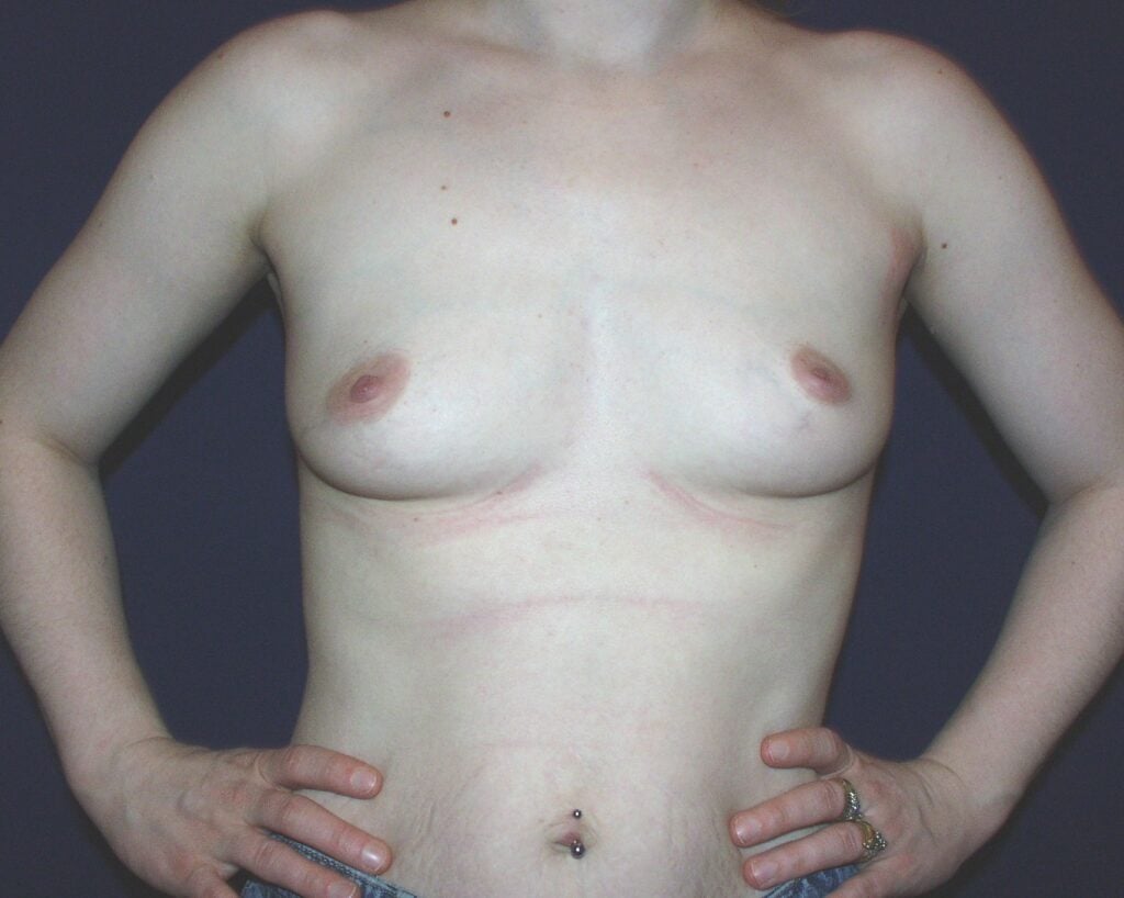 Before breast, 450cc, B to D cup