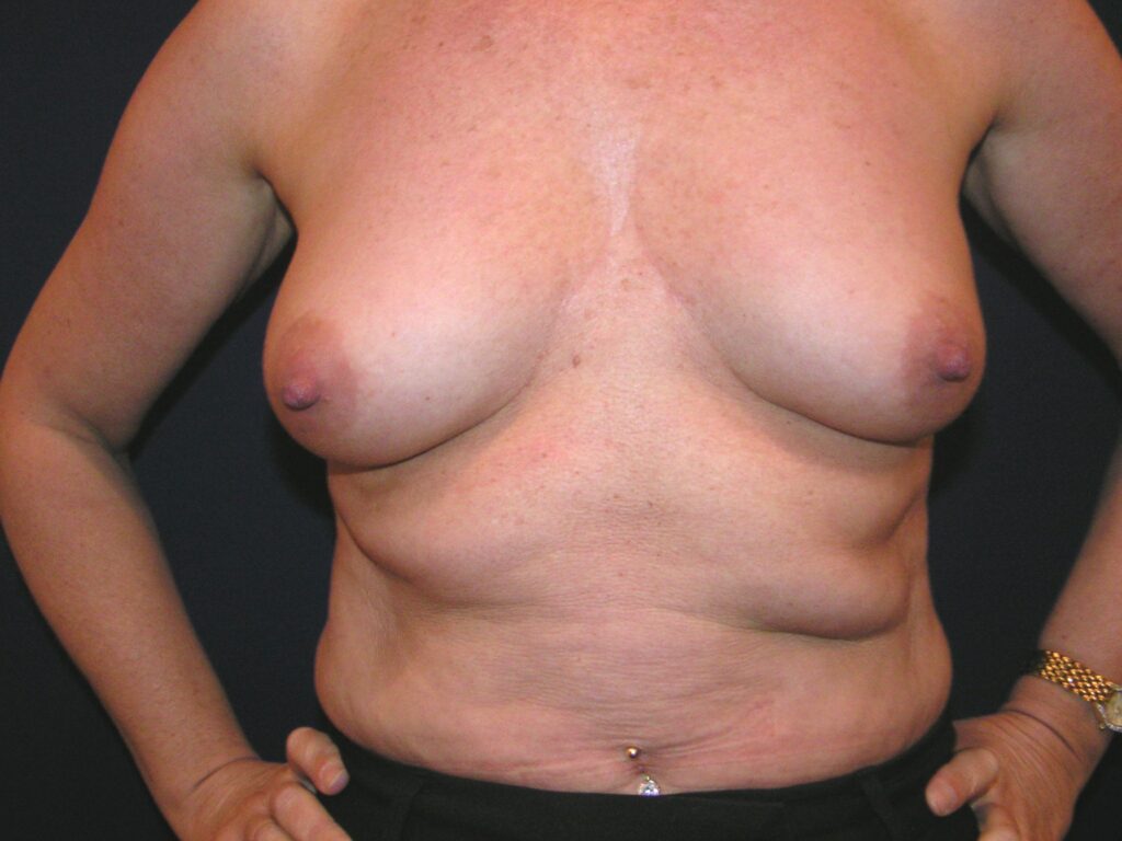 Before breast, 300cc, A to C cup