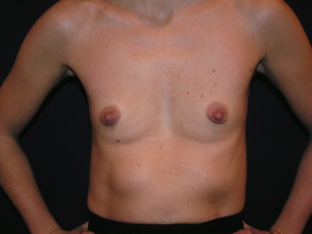 Before breast, 350cc, A to C cup
