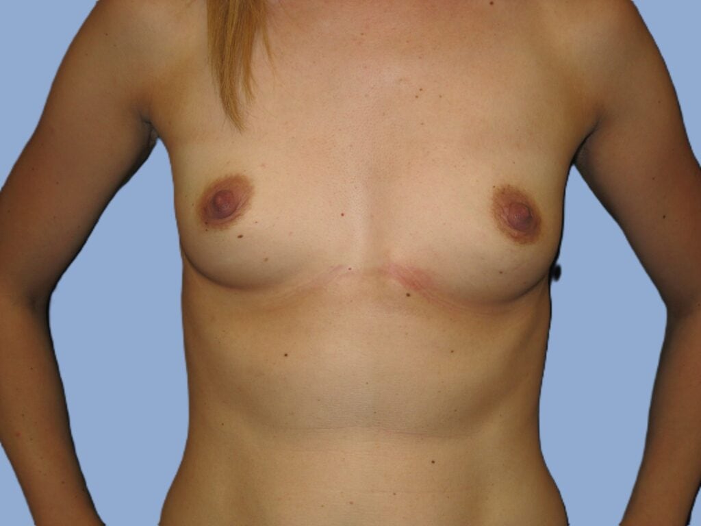 Before breast, 595cc, A to DD cup