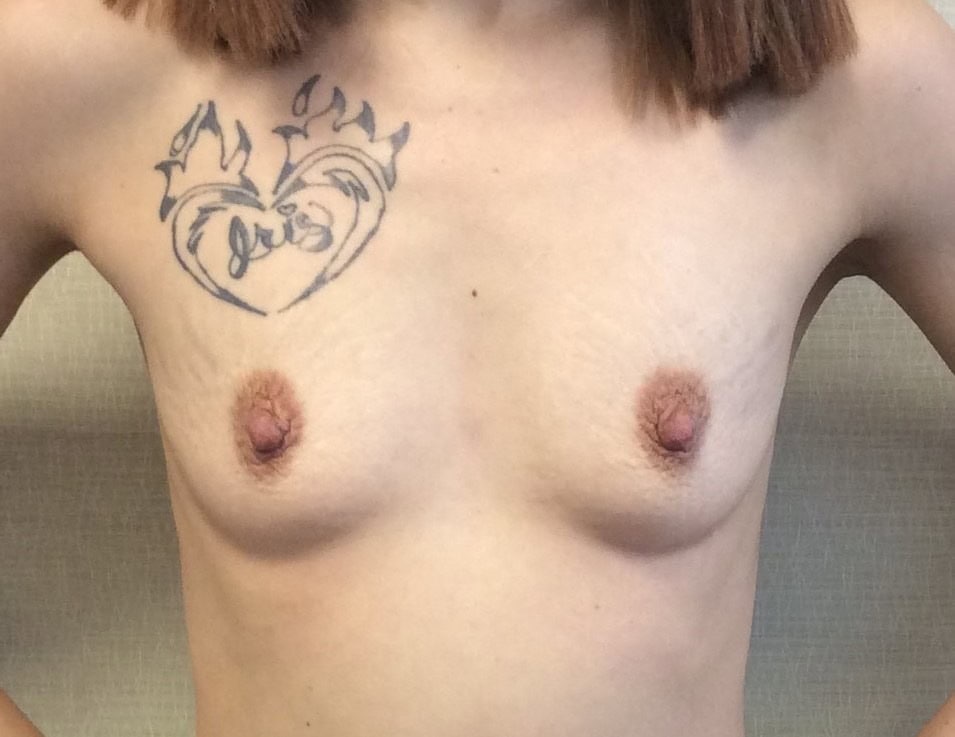 Before breast, 500cc, A to D cup